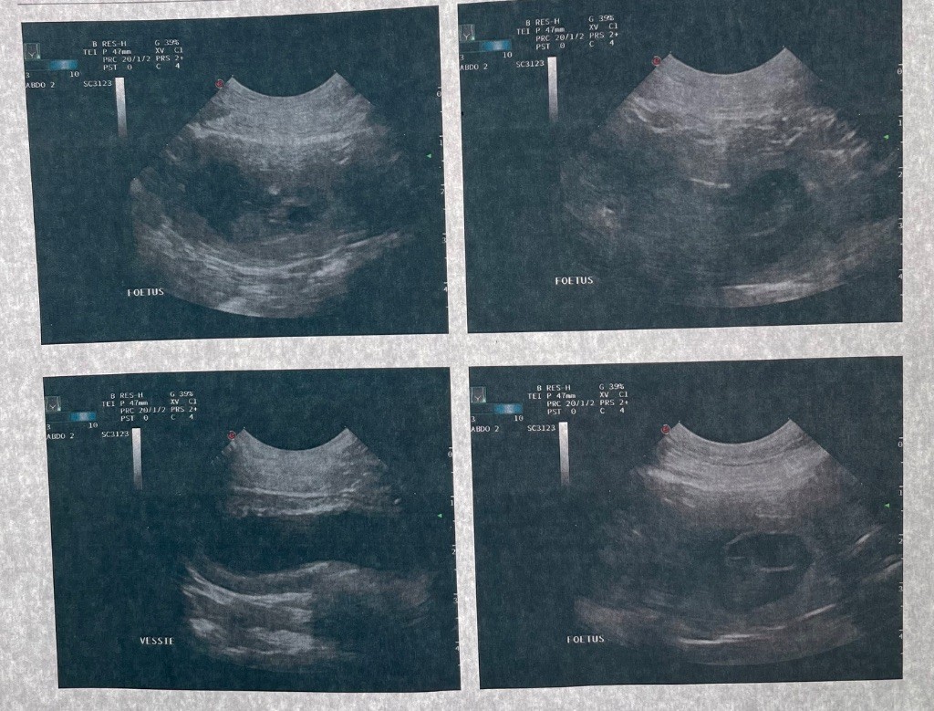 Gestation confirmée par échographie 